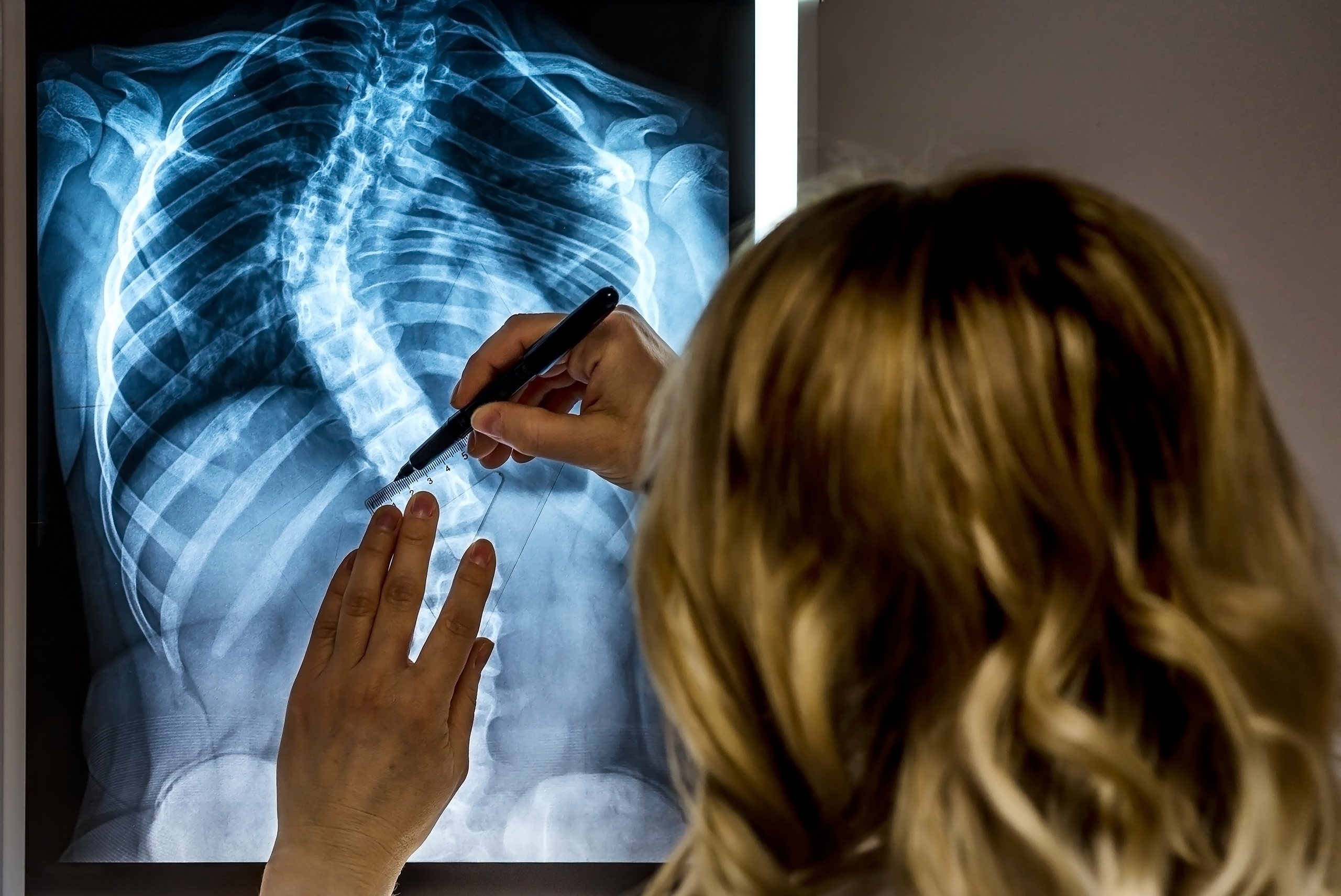 A physician explains an X-ray of a back in relation to spine surgery.