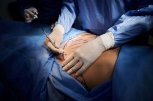 There are many differences in a tummy tuck vs. liposuction. This image is of a plastic surgeon marking a patient's stomach during a surgery.